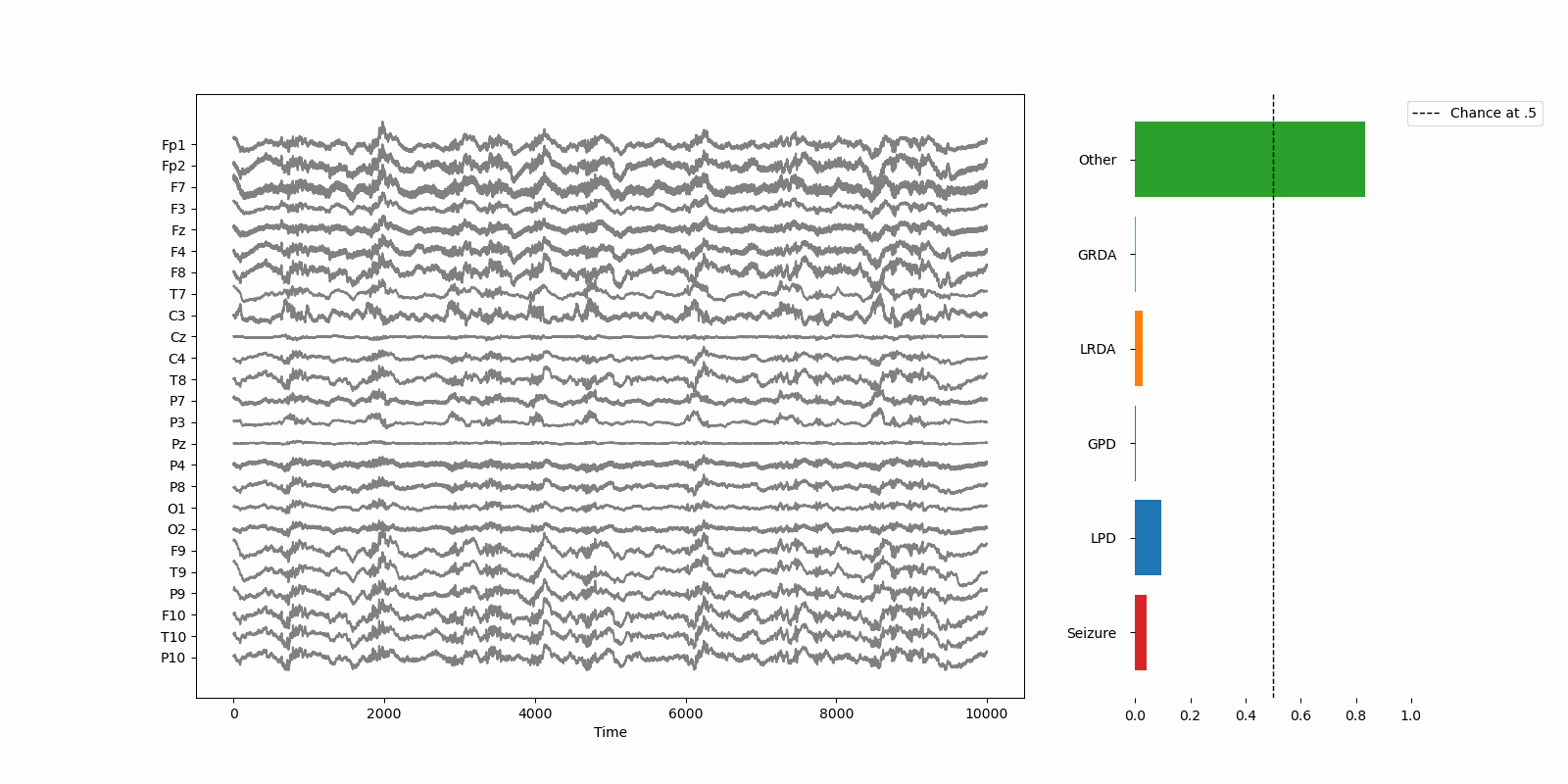 Seizure EEG pattern animation